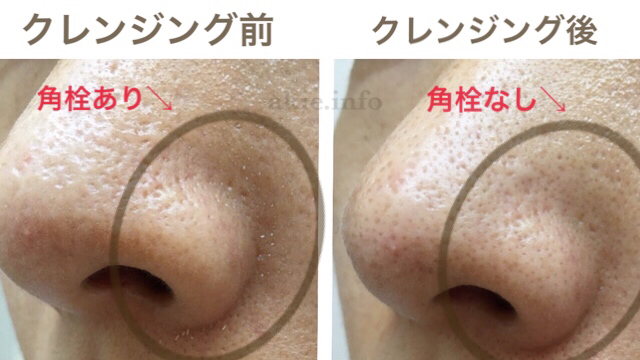 duoのクレンジングバーム黒を使う前と使った後のお肌状態を比較した画像