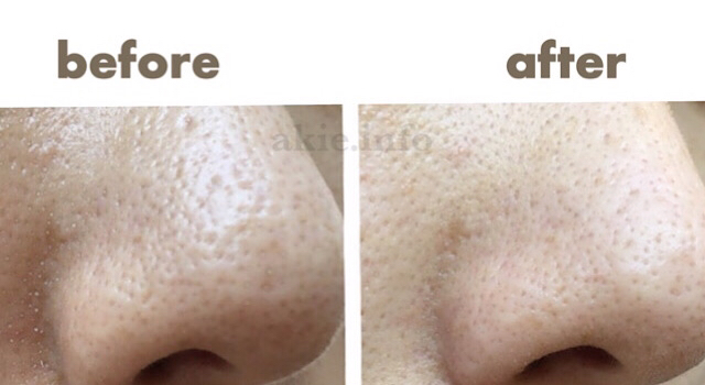 DUO酵素洗顔パウダーを使う前と使った後の比較画像